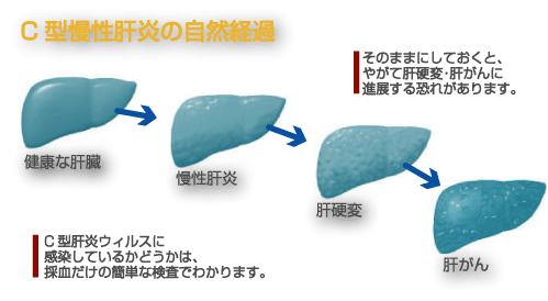 C型慢性肝炎の自然経過　健康な肝臓、慢性肝炎、肝硬変、肝がん　　そのままにしておくと、やがて肝硬変・肝がんに進展する恐れがあります。C型肝炎ウィルスに感染しているかどうかは、採血だけの簡単な検査でわかります。
