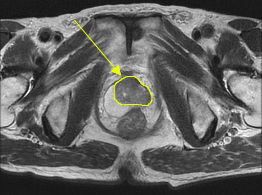 前立腺がんMRI