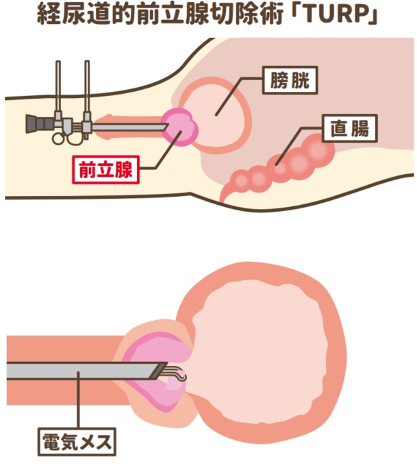経尿道的前立腺切除術