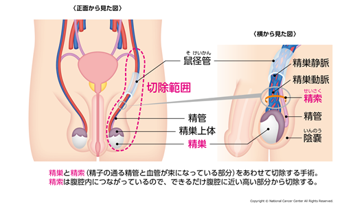 高位精巣摘除術